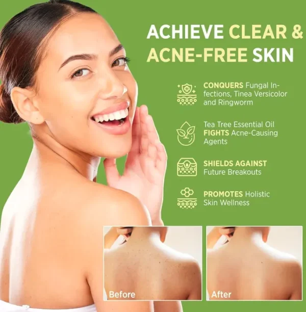 Derm Antifungal Tea Tree Soap: Facial & Body Treatment